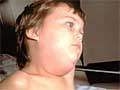 Child with mumps