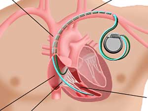 Surrogates often make call to deactivate heart devices