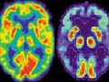 Alzheimer's damage