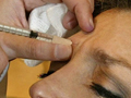 Botox injection