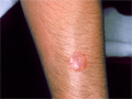 Ringworm