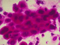 Cervical cancer