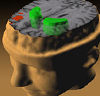 Illustration of Schizophrenia's effect on the ... 