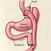 Image of bariatric surgery procedure 