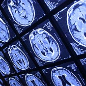 Brain scans to detect cancer 