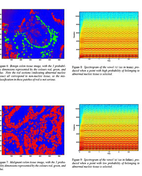 
                    Malignant and benign colon cells and their sound spectrograms.  Jonathan Berger "sonified" slices of these cells.  The malignant cells sound higher pitched than the benign ones.
                                            (--)
                                        