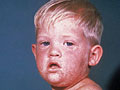Boy with measles