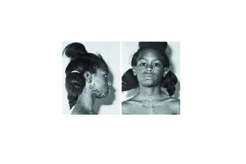 
                    Poet and writer Karen S. Williams, 1969, at age seven, upon starting care with renowned American dermatologist, Dr. Clarence Livingood.
                                            (Courtesy Karen Williams)
                                        