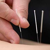 Acupuncture 