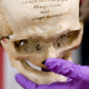 A skull from the Mutter Museum