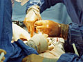 Kidney transplant