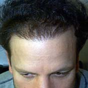 A patient after a successful hair transplant 
