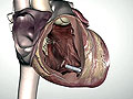 New pacemaker location