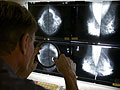 Mammogram