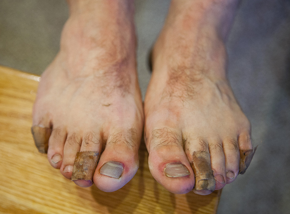 Lee Peyton's blistered and bruised feet