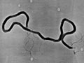 Syphilis